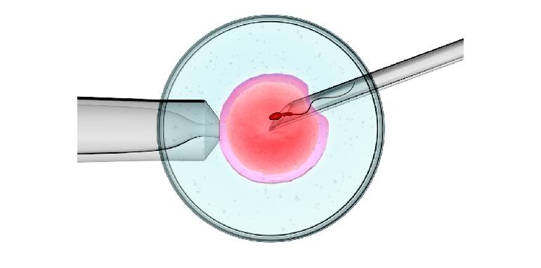 ICSI Treatment Mira Road Bhayandar